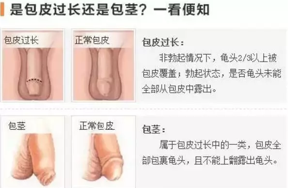 宝鸡海拉苏镇中心卫生院包皮手术多久能性生活