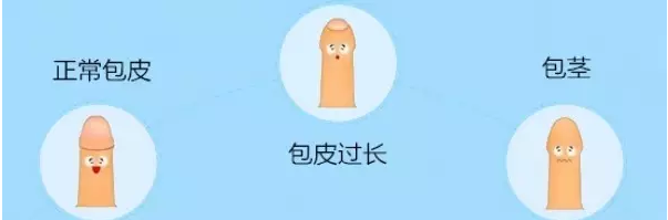 宝鸡红山区阴茎龟头包皮里白白的是什么