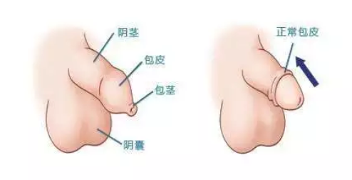 宝鸡红山区男人什么样的包皮为过长